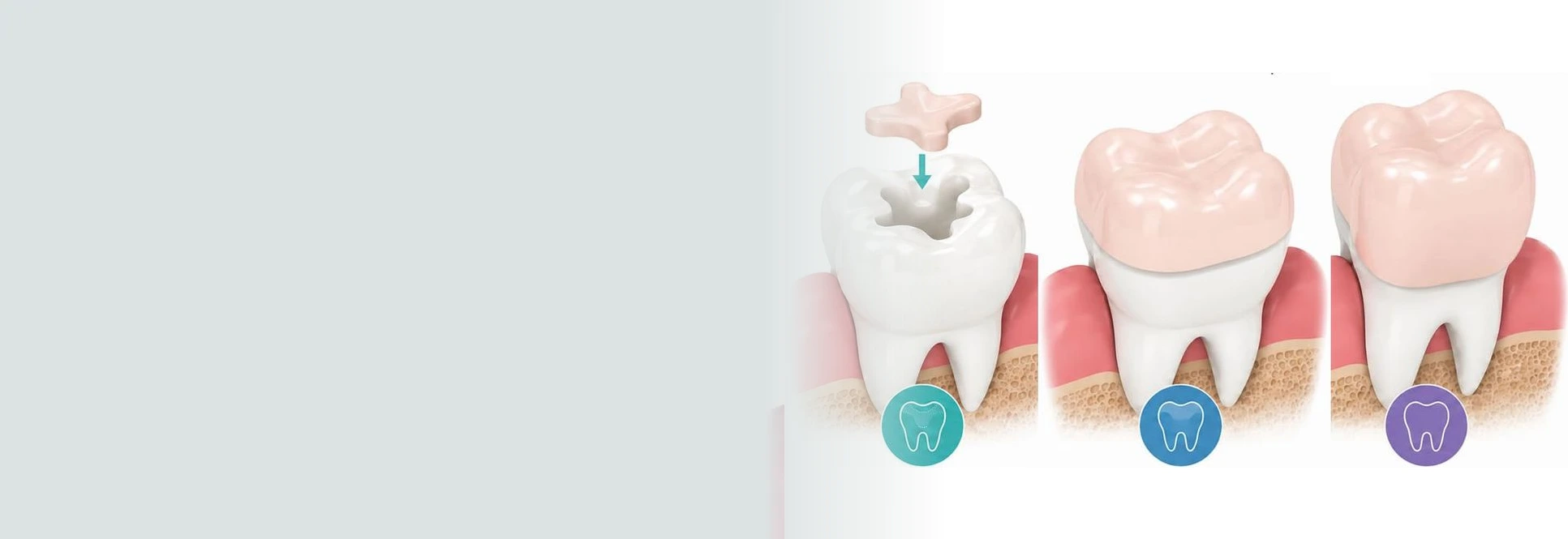 Dental inlays and onlays in Taylor
